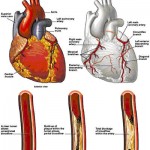 heart-attack-01